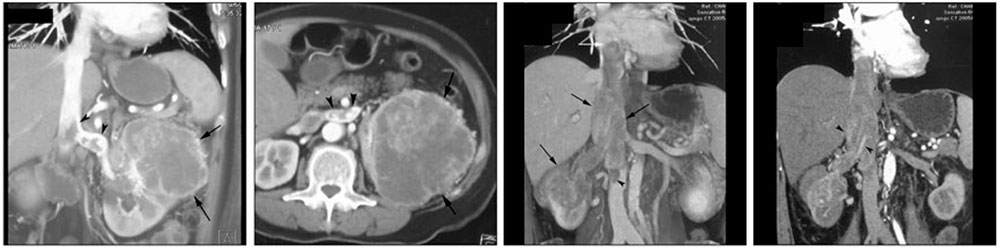 IVC thrombosisMalignant thrombus